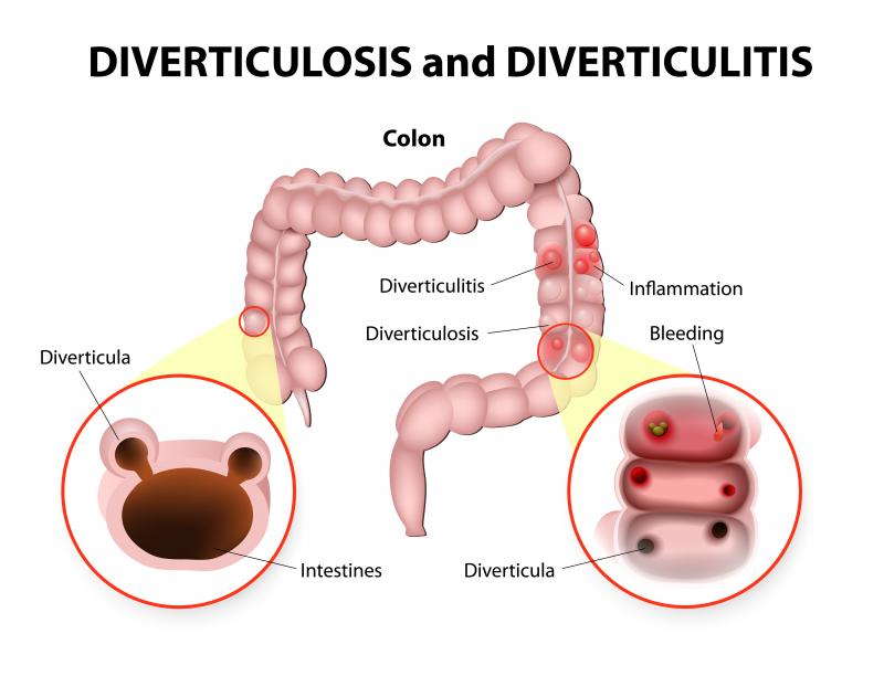 Treatment of diverticulitis involves multiple specialties | Cape Gazette