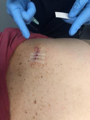 The back surgery is also healing well.